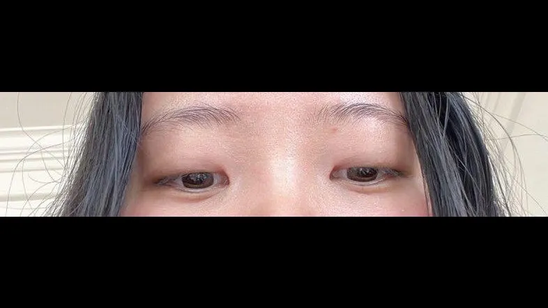 Incisional Double Eyelid Surgery, Ptosis Correction — RE&RE PLASTIC SURGERY 2