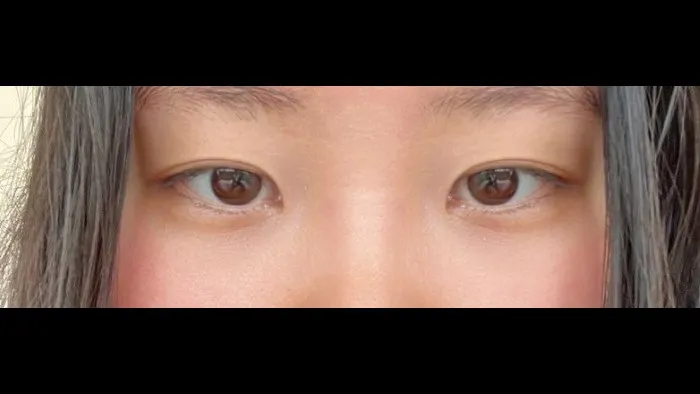 Incisional Double Eyelid Surgery, Ptosis Correction — RE&RE PLASTIC SURGERY 3