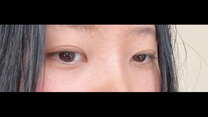 Incisional Double Eyelid Surgery, Ptosis Correction — RE&RE PLASTIC SURGERY 4