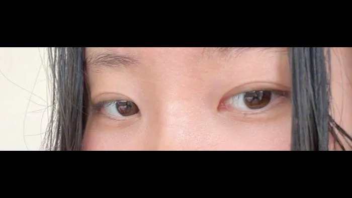 Incisional Double Eyelid Surgery, Ptosis Correction — RE&RE PLASTIC SURGERY 5
