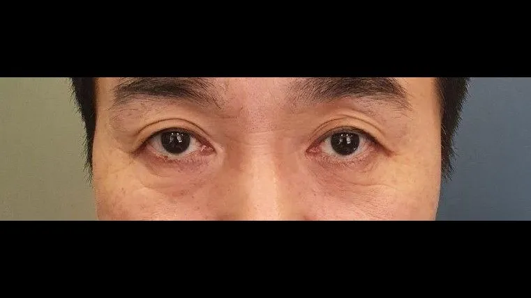 Sub-brow Lift, Lower Blepharoplasty (Aging Eye Rejuvenation), Lower Eyelid Fat Grafting, Midface Lift 1
