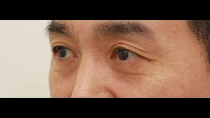 Sub-brow Lift, Lower Blepharoplasty (Aging Eye Rejuvenation), Lower Eyelid Fat Grafting, Midface Lift — RE&RE PLASTIC SURGERY 2