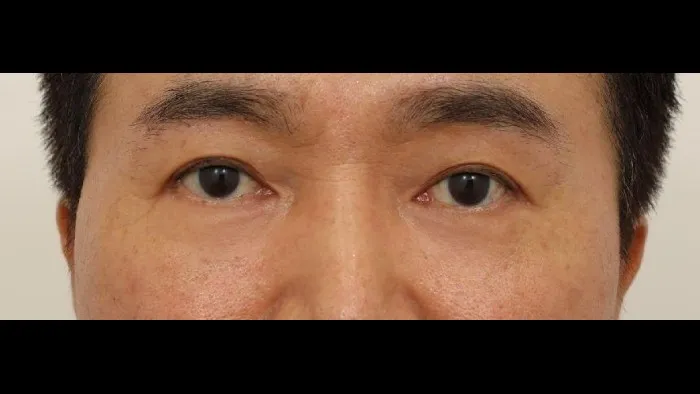 Sub-brow Lift, Lower Blepharoplasty (Aging Eye Rejuvenation), Lower Eyelid Fat Grafting, Midface Lift — RE&RE PLASTIC SURGERY 3