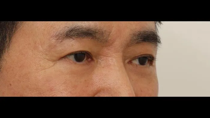 Sub-brow Lift, Lower Blepharoplasty (Aging Eye Rejuvenation), Lower Eyelid Fat Grafting, Midface Lift — RE&RE PLASTIC SURGERY 4