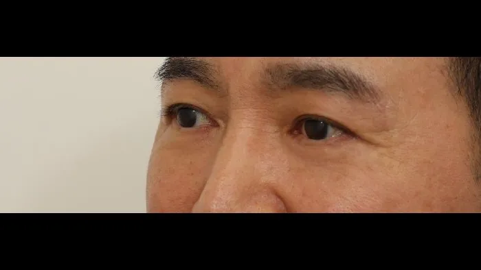Sub-brow Lift, Lower Blepharoplasty (Aging Eye Rejuvenation), Lower Eyelid Fat Grafting, Midface Lift — RE&RE PLASTIC SURGERY 5