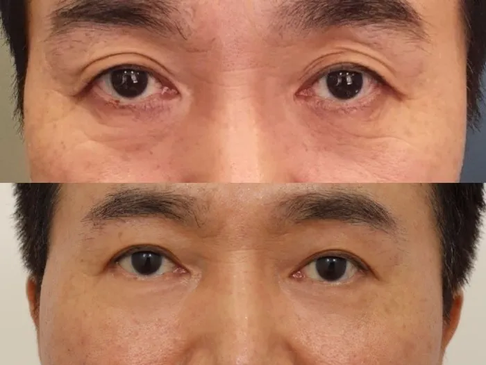 Sub-brow Lift, Lower Blepharoplasty (Aging Eye Rejuvenation), Lower Eyelid Fat Grafting, Midface Lift — RE&RE PLASTIC SURGERY 6