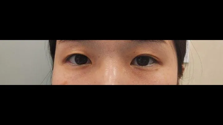 Natural Adhesion Double Eyelid Surgery, Ptosis Correction 1