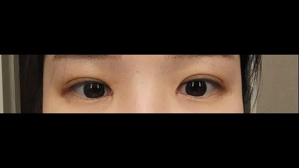 Natural Adhesion Double Eyelid Surgery, Ptosis Correction — RE&RE PLASTIC SURGERY 2