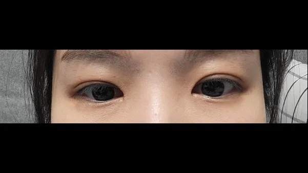 Natural Adhesion Double Eyelid Surgery, Ptosis Correction — RE&RE PLASTIC SURGERY 3