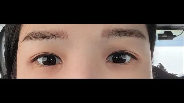Natural Adhesion Double Eyelid Surgery, Ptosis Correction — RE&RE PLASTIC SURGERY 4