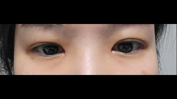 Natural Adhesion Double Eyelid Surgery, Ptosis Correction — RE&RE PLASTIC SURGERY 5
