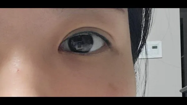 Natural Adhesion Double Eyelid Surgery, Ptosis Correction — RE&RE PLASTIC SURGERY 6