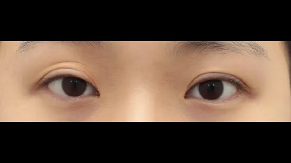 切开法(双眼皮), 眼型矫正术 1
