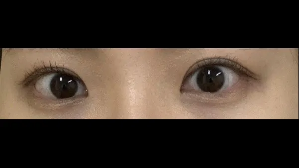 切开法（双眼皮）, 眼型矫正术 — RE&RE PLASTIC SURGERY 2