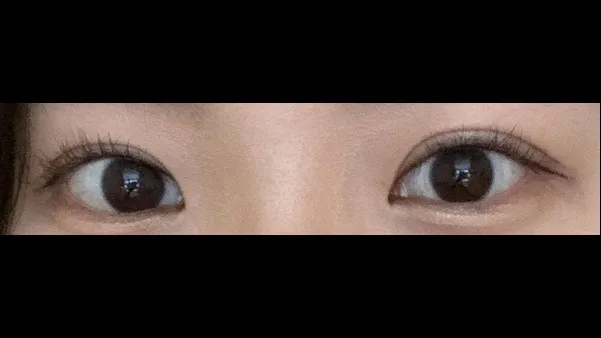 切开法（双眼皮）, 眼型矫正术 — RE&RE PLASTIC SURGERY 3