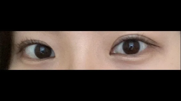 切开法（双眼皮）, 眼型矫正术 — RE&RE PLASTIC SURGERY 4