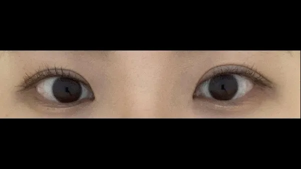 切开法（双眼皮）, 眼型矫正术 — RE&RE PLASTIC SURGERY 5