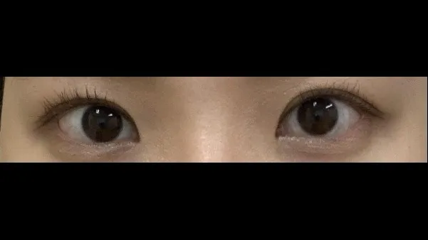 切开法（双眼皮）, 眼型矫正术 — RE&RE PLASTIC SURGERY 6