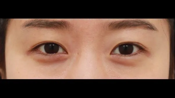 Natural Adhesion Double Eyelid Surgery 1