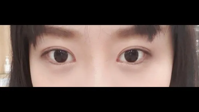 Natural Adhesion Double Eyelid Surgery 2