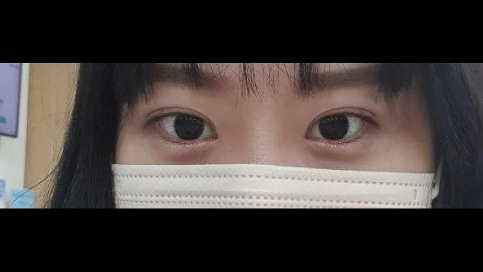 自然癒着法 — RE&RE PLASTIC SURGERY 3