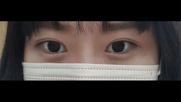 自然癒着法 — RE&RE PLASTIC SURGERY 4