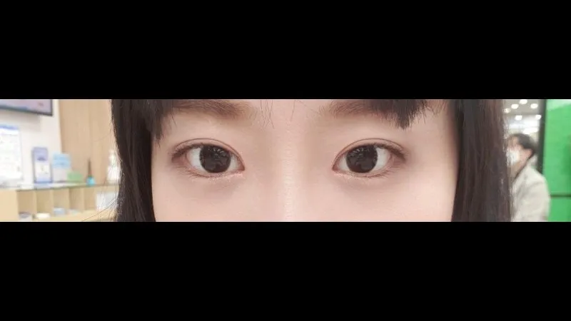 自然癒着法 — RE&RE PLASTIC SURGERY 5