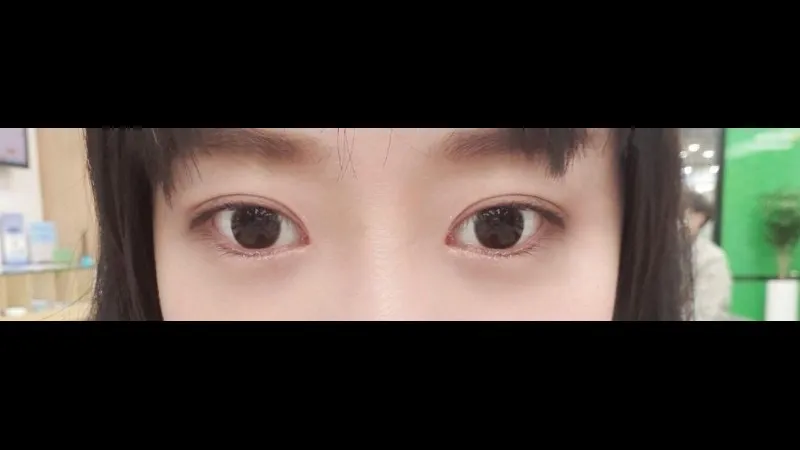 自然癒着法 — RE&RE PLASTIC SURGERY 6