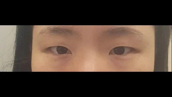 Natural Adhesion Double Eyelid Surgery 1