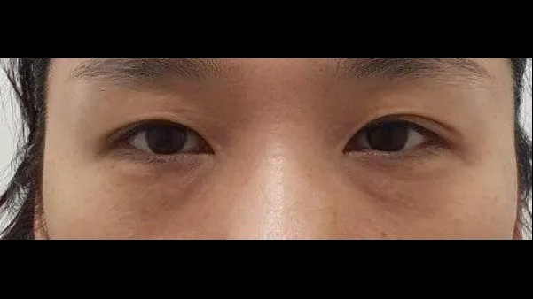 Sub-brow Lift, Lower Blepharoplasty (Aging Eye Rejuvenation) 1