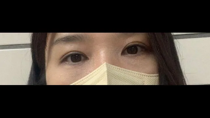 Sub-brow Lift, Lower Blepharoplasty (Aging Eye Rejuvenation) 2