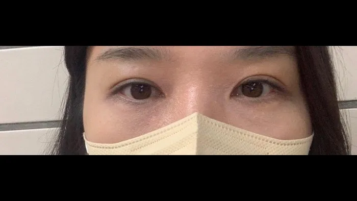 眉下リフト, 下眼瞼形成(中高年の目元) — RE&RE PLASTIC SURGERY 5