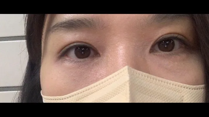 眉下リフト, 下眼瞼形成(中高年の目元) — RE&RE PLASTIC SURGERY 6