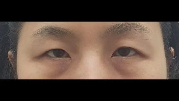 Sub-brow Lift 1