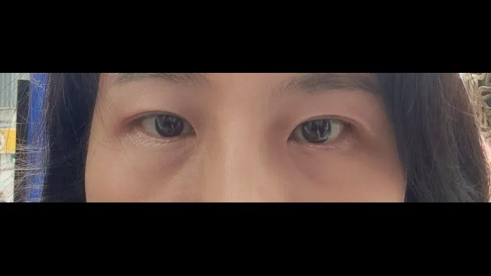 Sub-brow Lift 2