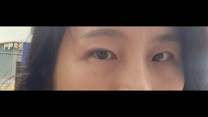 Sub-brow Lift — RE&RE PLASTIC SURGERY 3