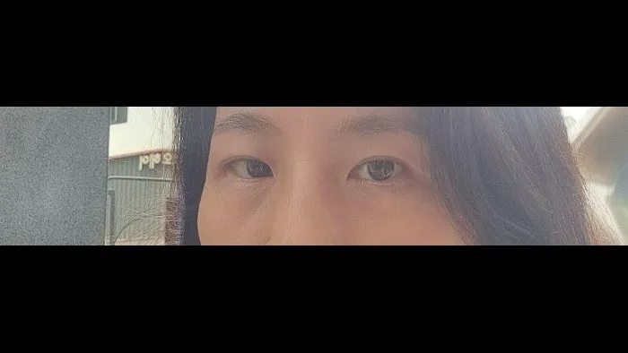 Sub-brow Lift — RE&RE PLASTIC SURGERY 4