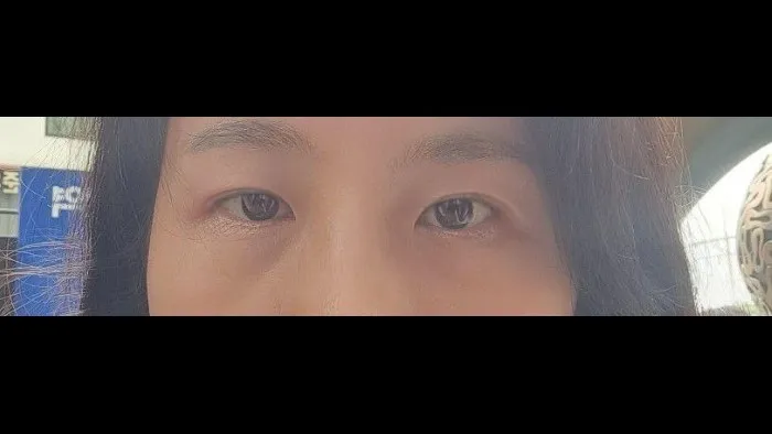 Sub-brow Lift — RE&RE PLASTIC SURGERY 5