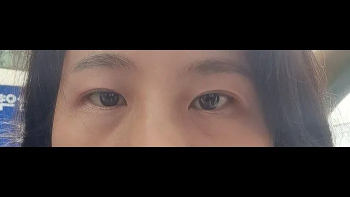 Sub-brow Lift — RE&RE PLASTIC SURGERY 6
