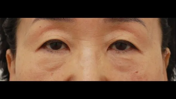 Sub-brow Lift, Lower Blepharoplasty (Aging Eye Rejuvenation), Midface Lift 1