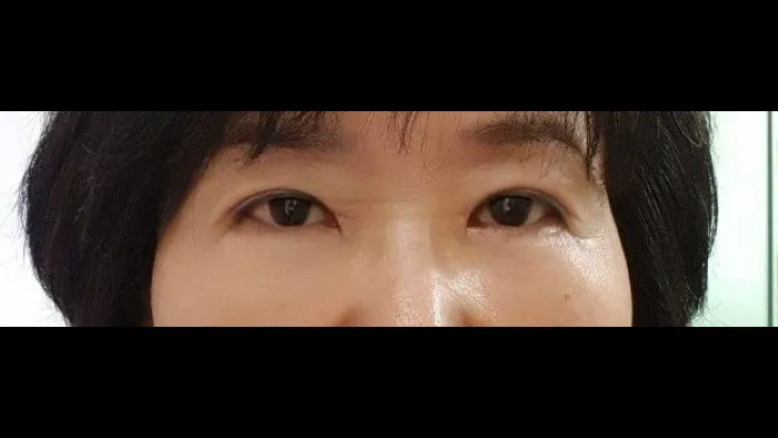 Sub-brow Lift, Lower Blepharoplasty (Aging Eye Rejuvenation), Midface Lift — RE&RE PLASTIC SURGERY 2