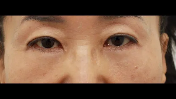 Sub-brow Lift, Lower Blepharoplasty (Aging Eye Rejuvenation), Midface Lift — RE&RE PLASTIC SURGERY 3