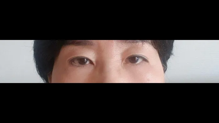 Sub-brow Lift, Lower Blepharoplasty (Aging Eye Rejuvenation), Midface Lift — RE&RE PLASTIC SURGERY 4