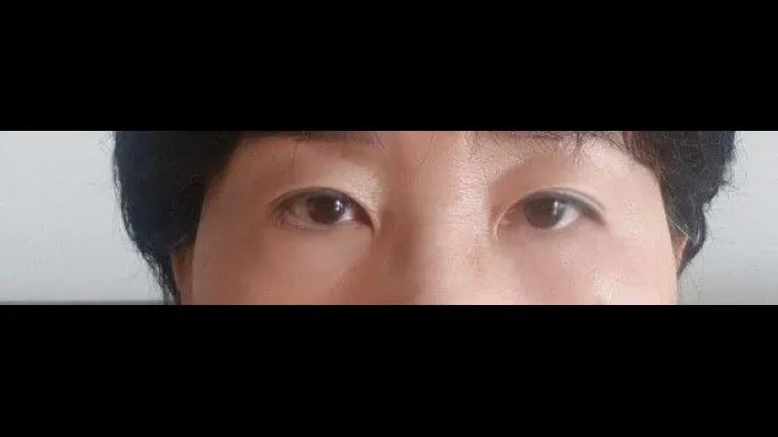 Sub-brow Lift, Lower Blepharoplasty (Aging Eye Rejuvenation), Midface Lift — RE&RE PLASTIC SURGERY 5
