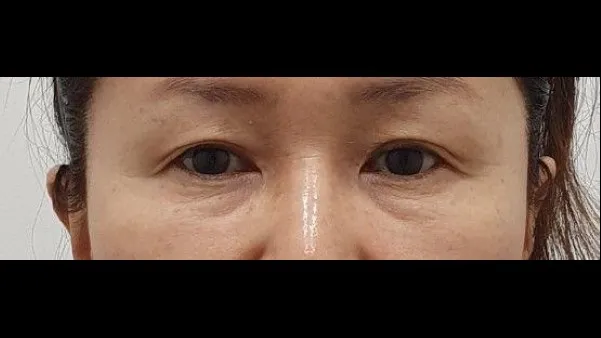 Sub-brow Lift, Lower Blepharoplasty (Aging Eye Rejuvenation), Midface Lift — RE&RE PLASTIC SURGERY 1