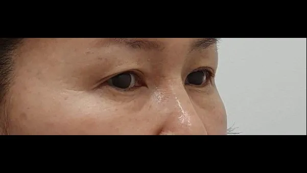 Sub-brow Lift, Lower Blepharoplasty (Aging Eye Rejuvenation), Midface Lift — RE&RE PLASTIC SURGERY 2