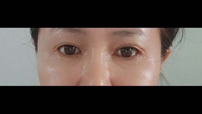 Sub-brow Lift, Lower Blepharoplasty (Aging Eye Rejuvenation), Midface Lift — RE&RE PLASTIC SURGERY 3