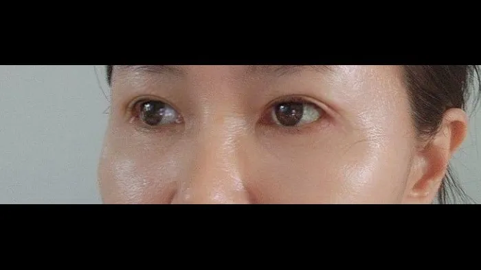 Sub-brow Lift, Lower Blepharoplasty (Aging Eye Rejuvenation), Midface Lift — RE&RE PLASTIC SURGERY 5