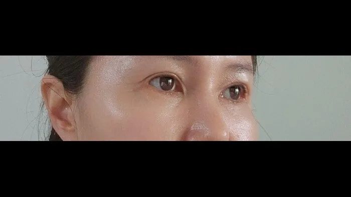 Sub-brow Lift, Lower Blepharoplasty (Aging Eye Rejuvenation), Midface Lift — RE&RE PLASTIC SURGERY 6