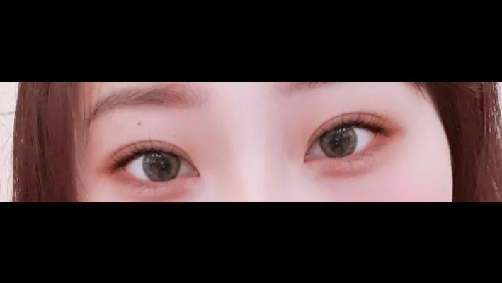 Partial Incision Double Eyelid Surgery, Ptosis Correction — RE&RE PLASTIC SURGERY 2